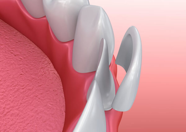 dental porcelain veneers